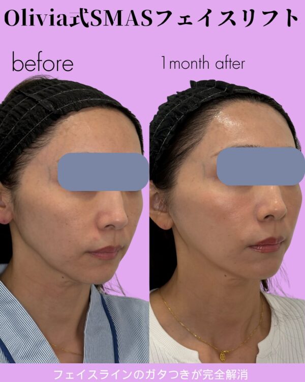 293 Olivia式SMASフェイスリフト