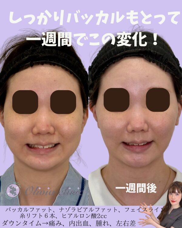 294 バッカルファット除去 × ナゾラビアルファット除去 × Olivia lift × ヒアルロン酸