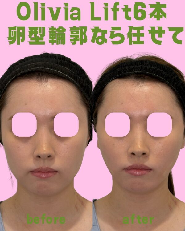 295 Olivia lift × ヒアルロン酸注入