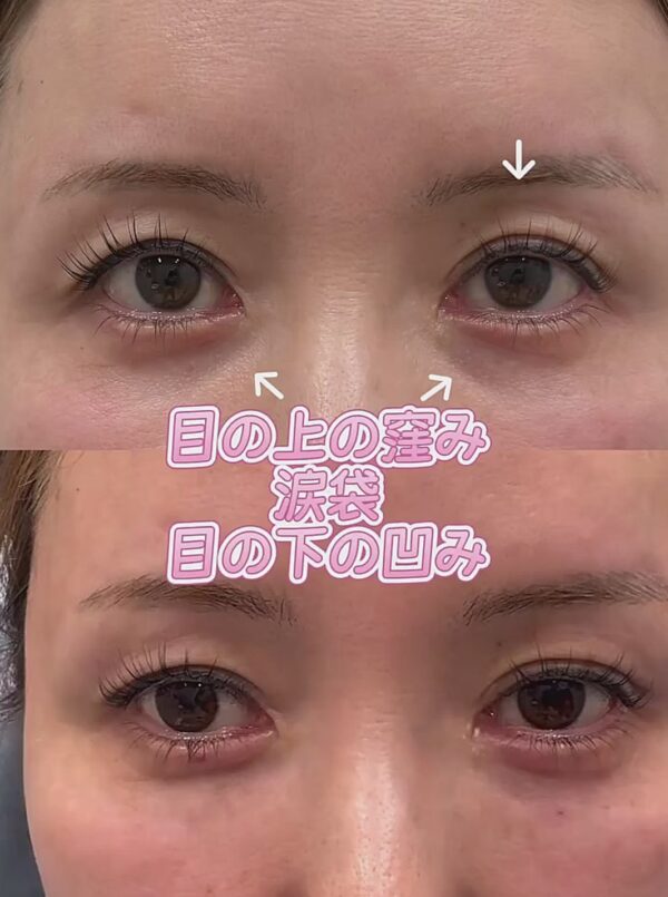 296 ヒアルロン酸注入