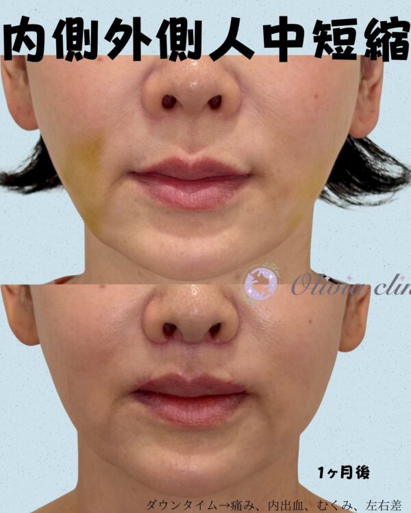 298 内側人中短縮 × 口角挙上術
