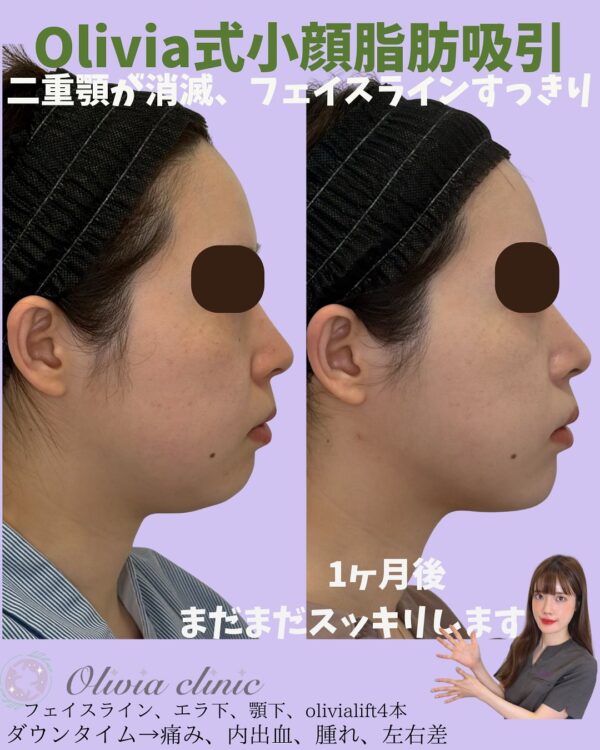 301 Olivia式小顔脂肪吸引 × Olivia lift