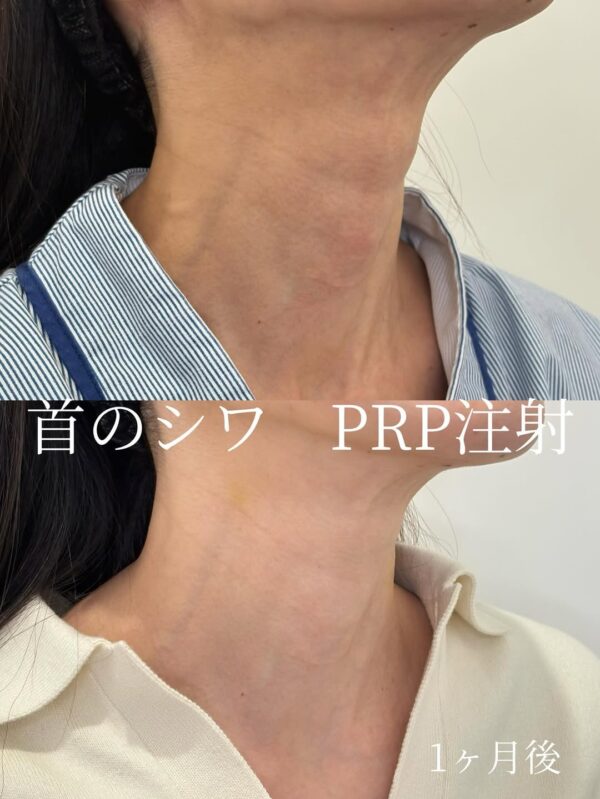 303 首のシワ PRP注射