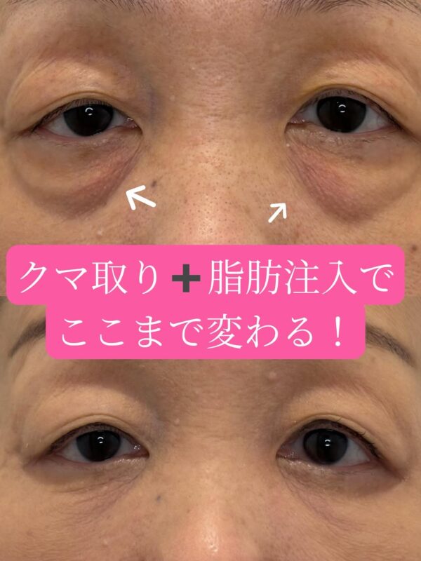 305 クマ取り（脱脂） × 脂肪注入