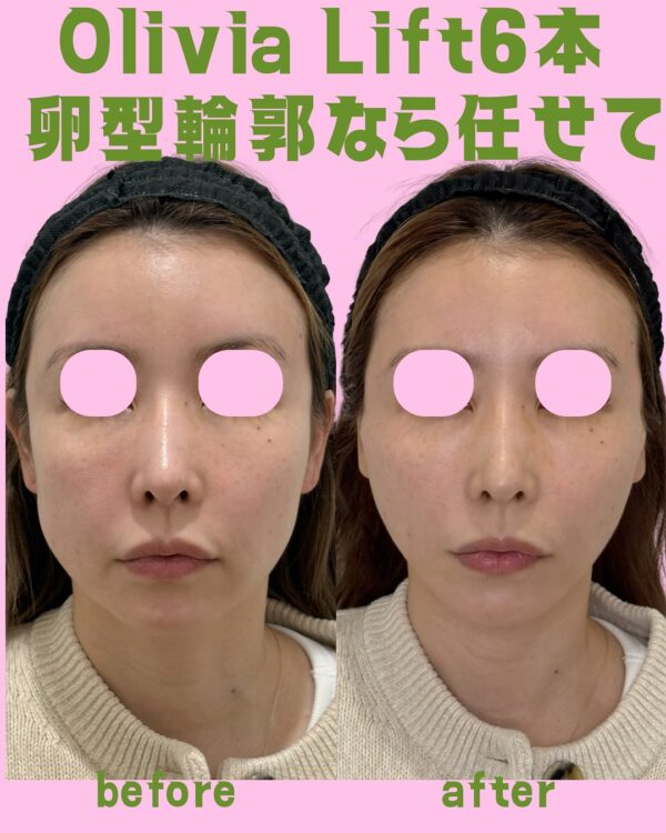 306 Olivia lift × ヒアルロン酸注入