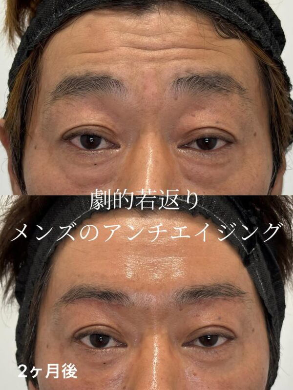 307 眉下リフト抜糸なし × ボツリヌストキシン × クマ取り × 脂肪注入