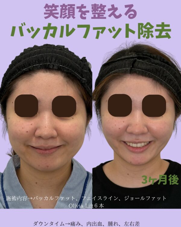 308 Olivia式小顔脂肪吸引 × バッカルファット除去 × ジョールファット除去 × Olivia lift