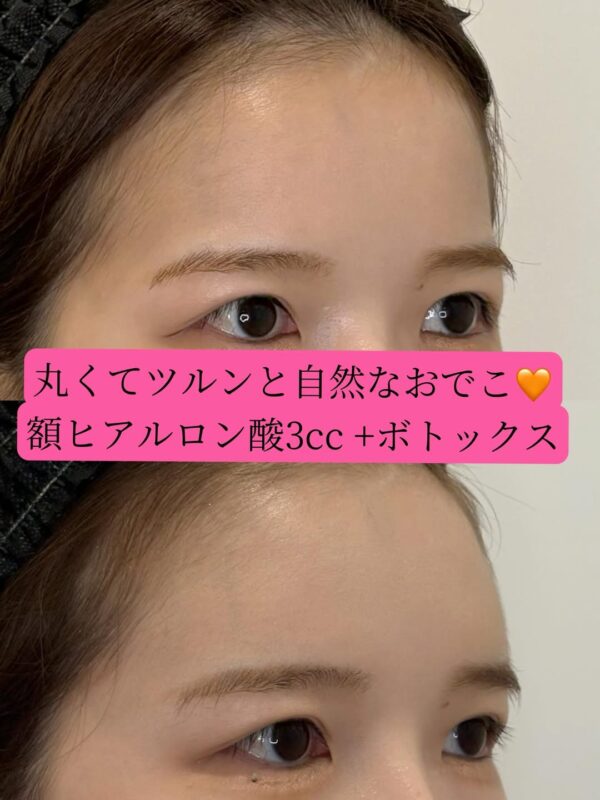 309 ヒアルロン酸 × ボツリヌストキシン