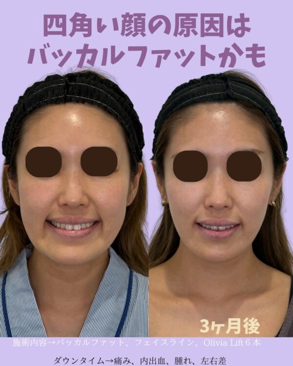 311 バッカルファット除去 × Olivia lift