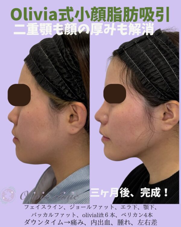 312 Olivia式小顔脂肪吸引 × バッカルファット除去 × ジョールファット除去 × Olivia lift × ペリカンリフト