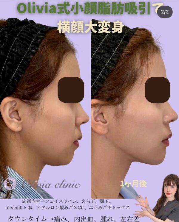 313 Olivia式小顔脂肪吸引 × Olivia lift × ヒアルロン酸 × ボツリヌストキシン