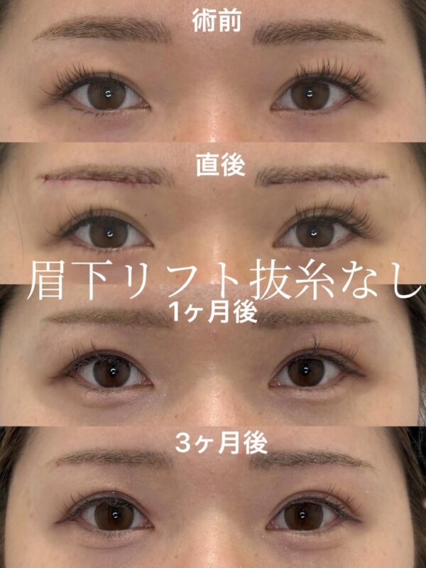 314 眉下リフト抜糸なし