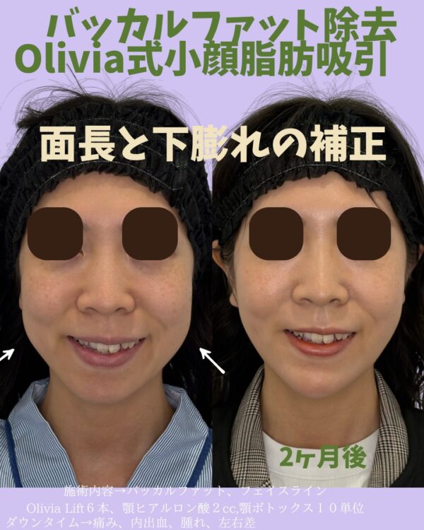 315 Olivia式小顔脂肪吸引 × バッカルファット除去  × フェイスライン × Olivia lift × ヒアルロン酸 × ボツリヌストキシン