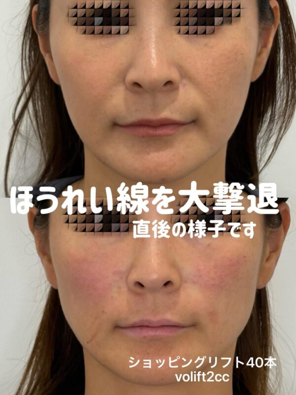 316 ショッピングリフト × ほうれい線ヒアルロン酸