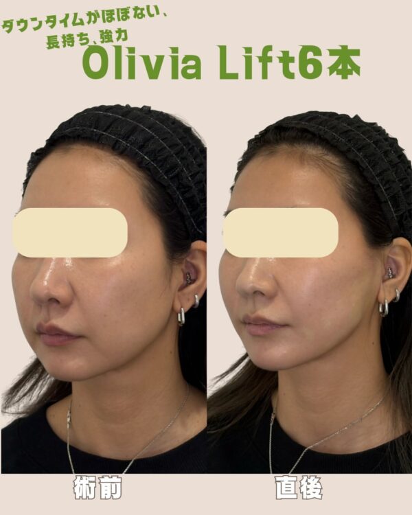 317 Olivia lift × ヒアルロン酸注入