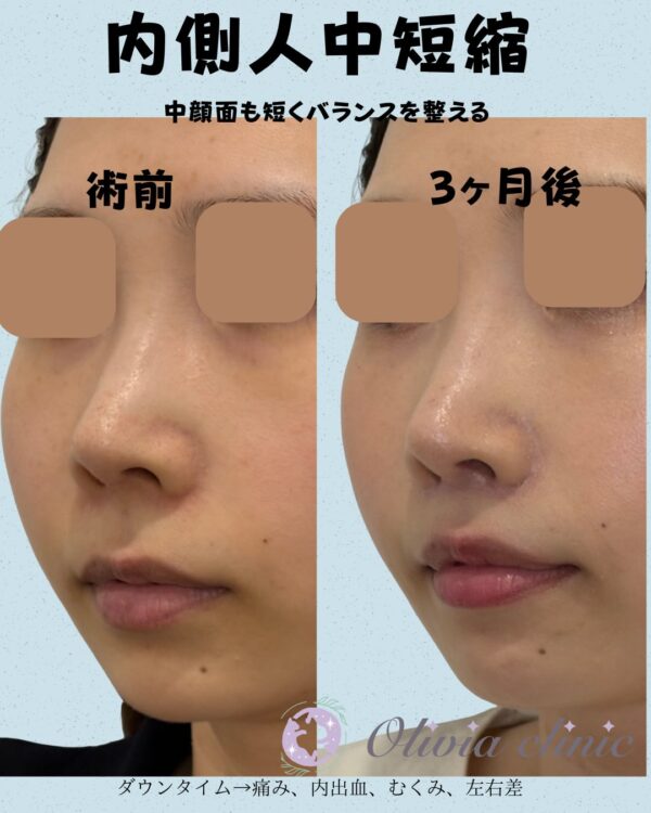 318 内側人中短縮