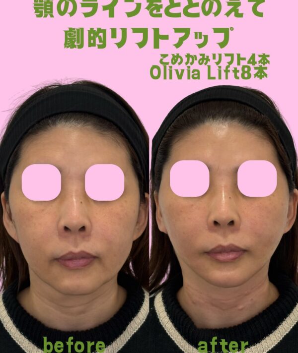 320 Olivia lift × ヒアルロン酸注入