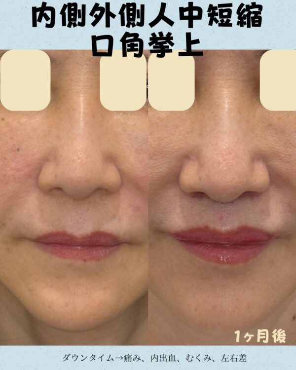321 内側外側人中短縮 × 口角挙上