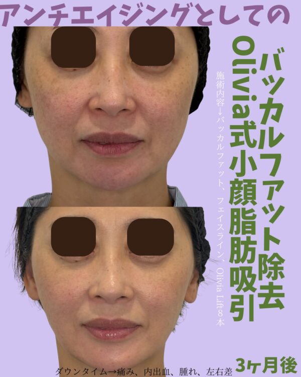 322 Olivia式小顔脂肪吸引 × バッカルファット除去  × フェイスライン × Olivia lift