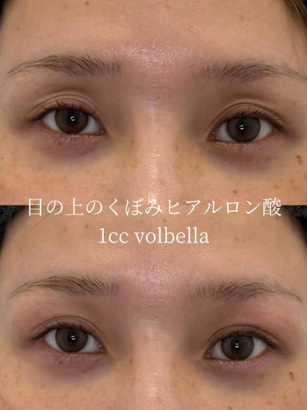 324 目の上の窪みヒアルロン酸注入