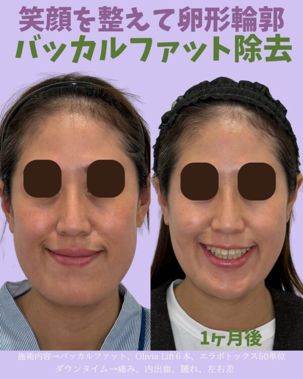 327 バッカルファット除去 × Olivia lift × ボツリヌストキシン注射