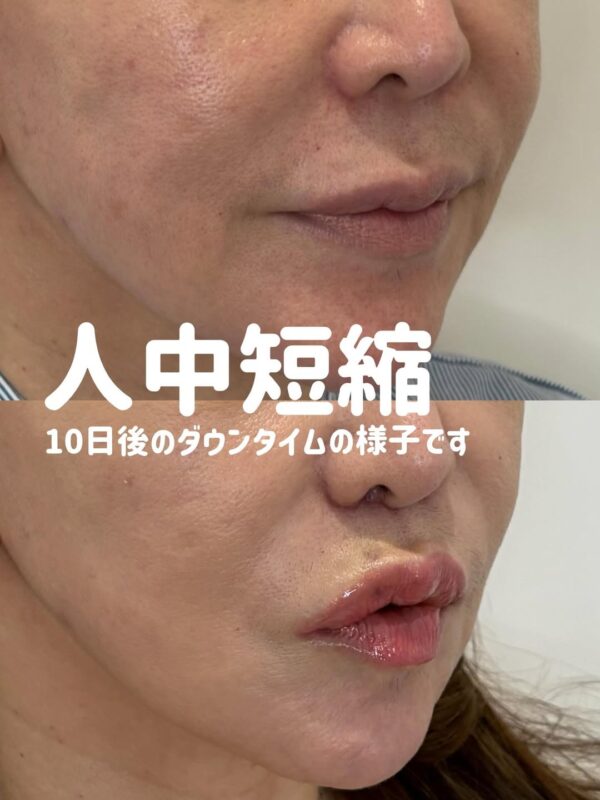 330 人中短縮 × ボツリヌストキシン注射