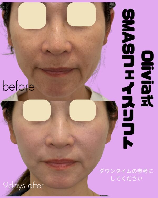331 Olivia式SMASフェイスリフト
