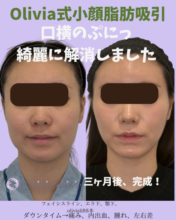 332 Olivia式小顔脂肪吸引 × バッカルファット除去  × フェイスライン × Olivia lift