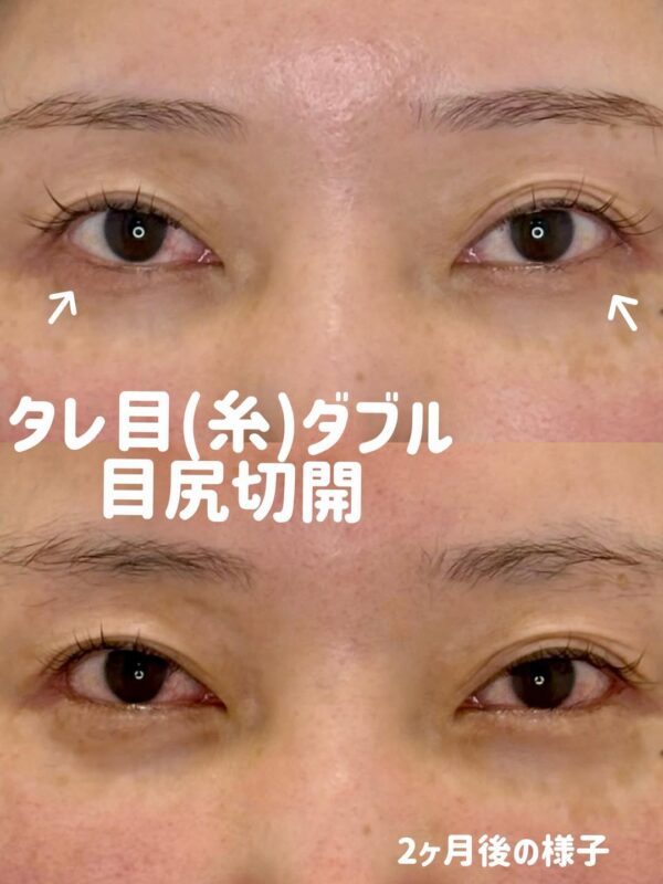 333 タレ目形成 × 目尻切開