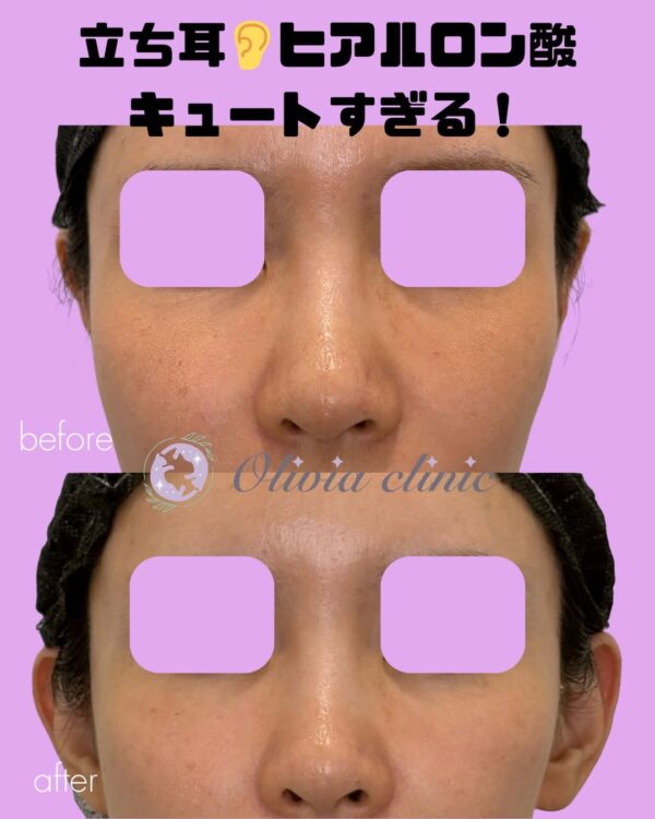 335 立ち耳ヒアルロン酸