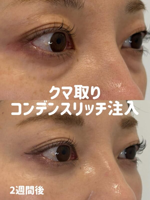 337 クマ取り（脱脂） × コンデンスリッチ脂肪注入