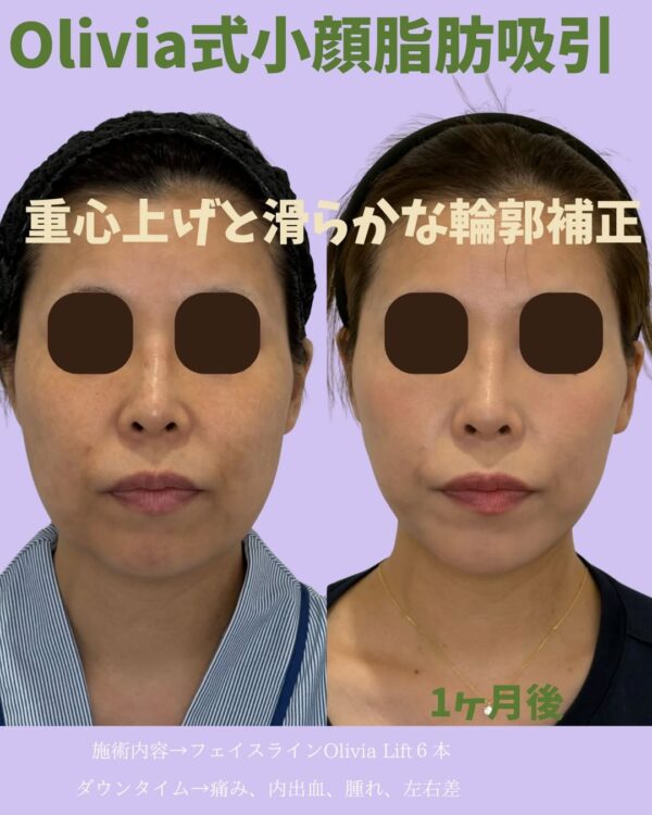 338 Olivia式小顔脂肪吸引 × Olivia lift