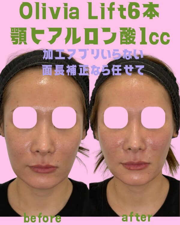 339 Olivia lift × 顎ヒアルロン酸注入