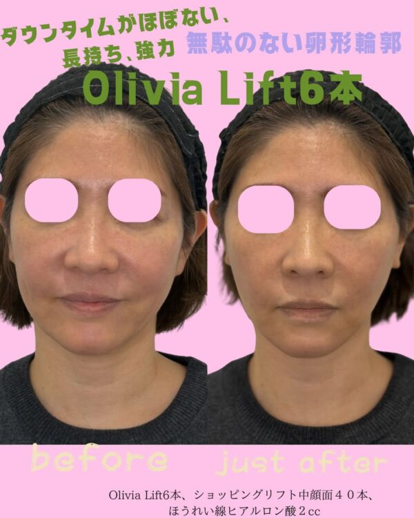 341 Olivia lift × ショッピングリフト × ほうれい線ヒアルロン酸