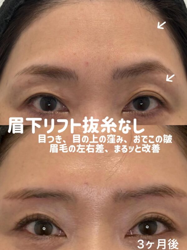 343 眉下リフト抜糸なし