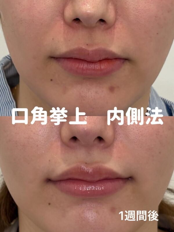 344 口角挙上内側法