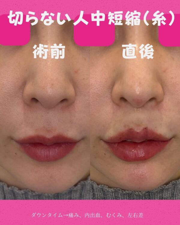 346 切らない人中短縮（糸）