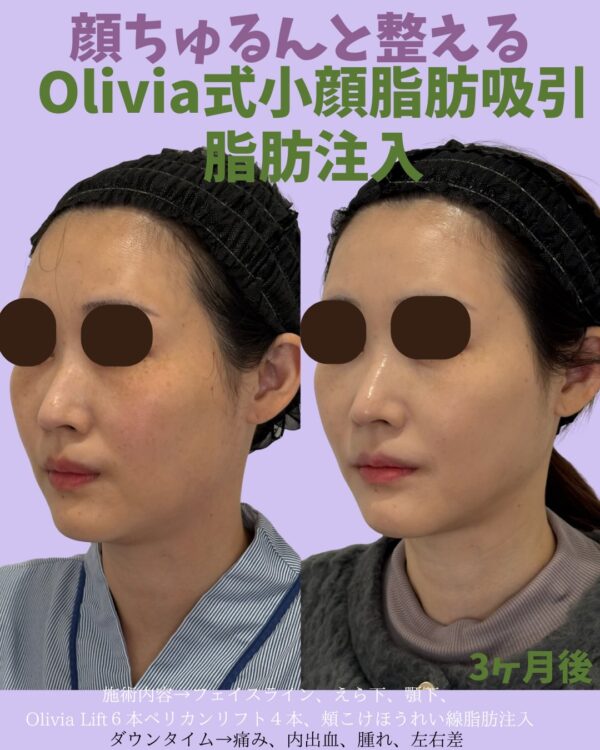 347 Olivia式小顔脂肪吸引 × Olivia lift × ペリカンリフト × 脂肪注入