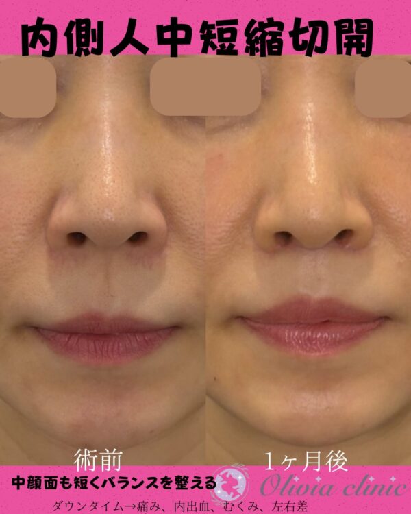 348 内側人中短縮切開