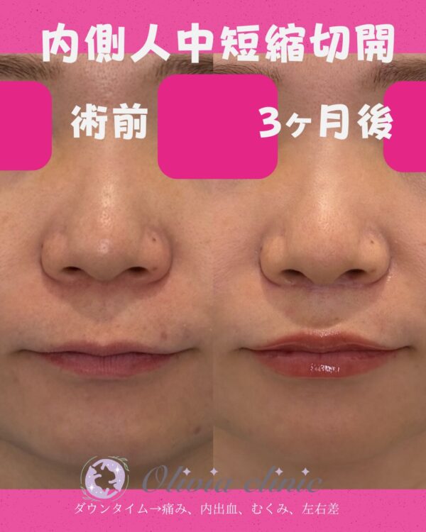 349 内側人中短縮切開