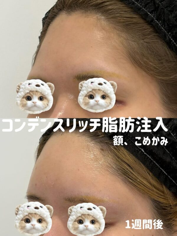 350 額 コンデンスリッチ脂肪注入