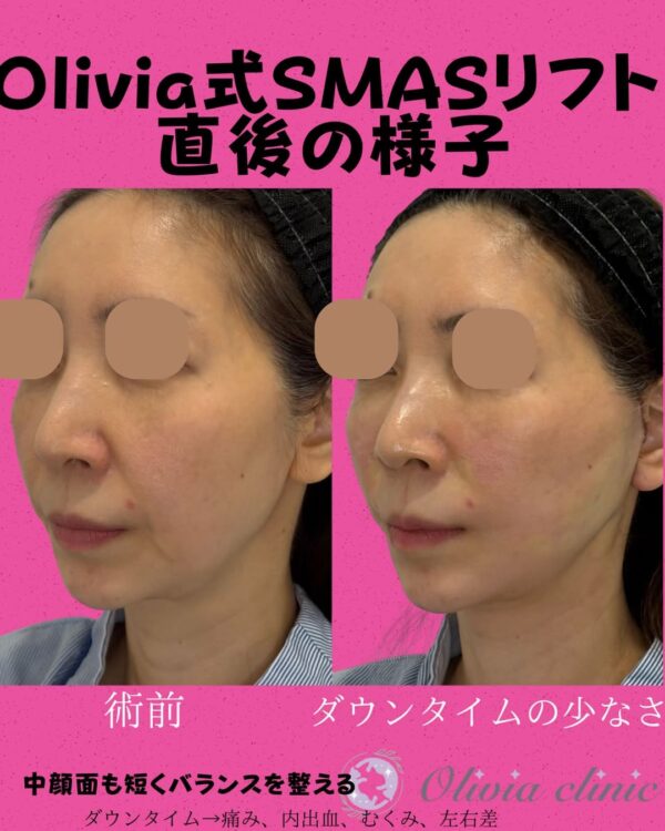 351 Olivia式SMASフェイスリフト