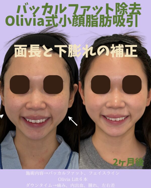 352 Olivia式小顔脂肪吸引 × バッカルファット除去  × フェイスライン × Olivia lift