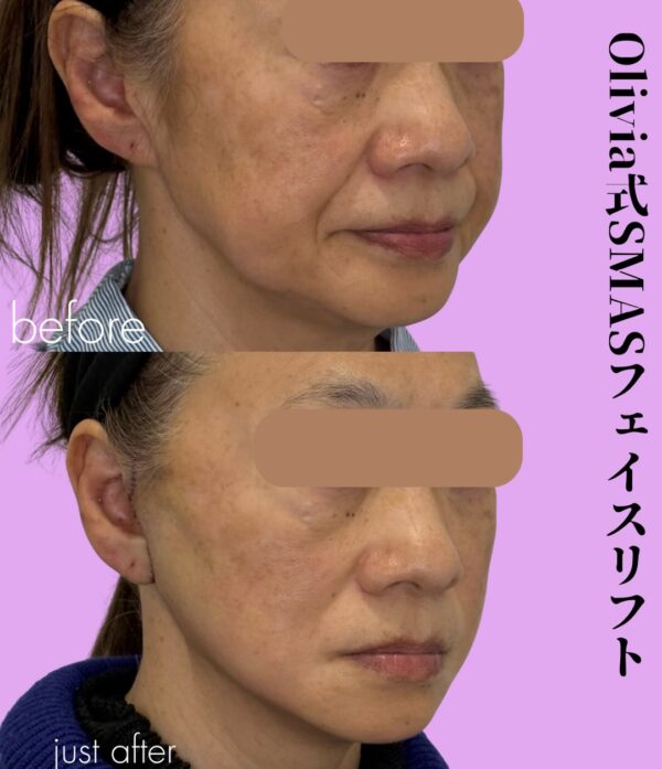 353 Olivia式SMASフェイスリフト