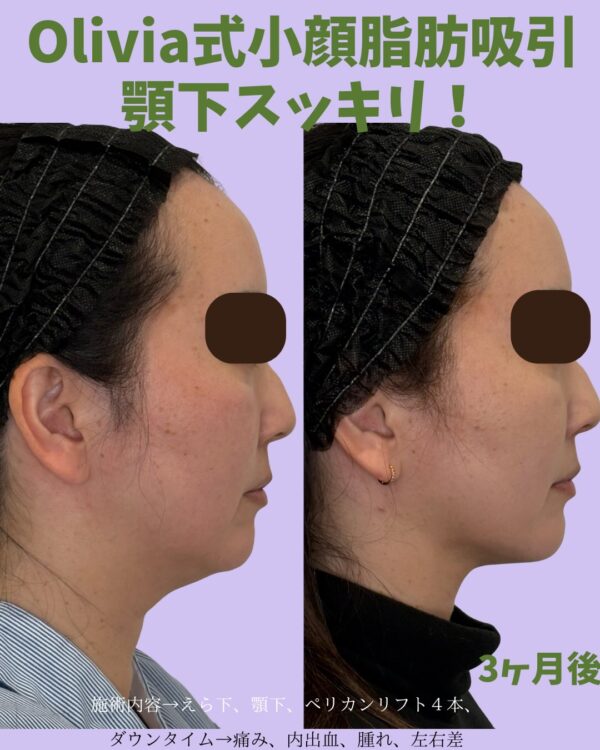 354 Olivia式小顔脂肪吸引 × Olivia lift × ペリカンリフト