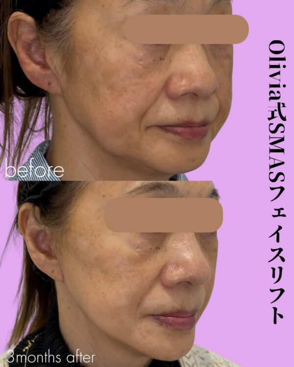 356 Olivia式SMASフェイスリフト