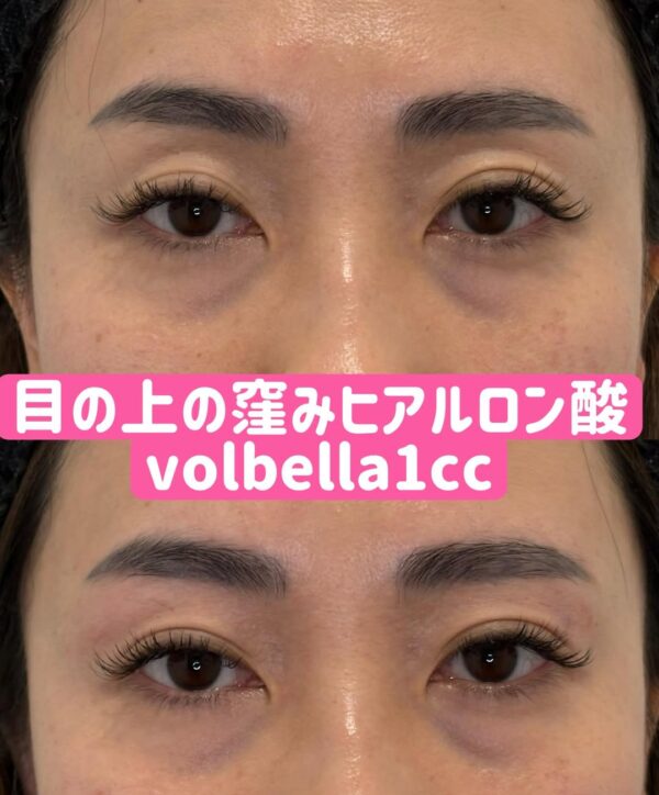 357 目の上のくぼみヒアルロン酸注入