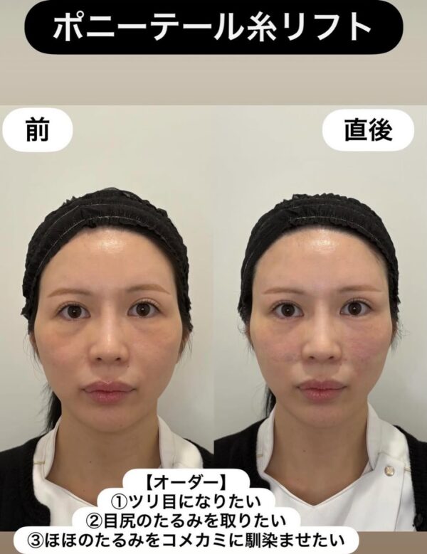 358 ショッピングリフト × ポニーテールリフト × 笑気麻酔