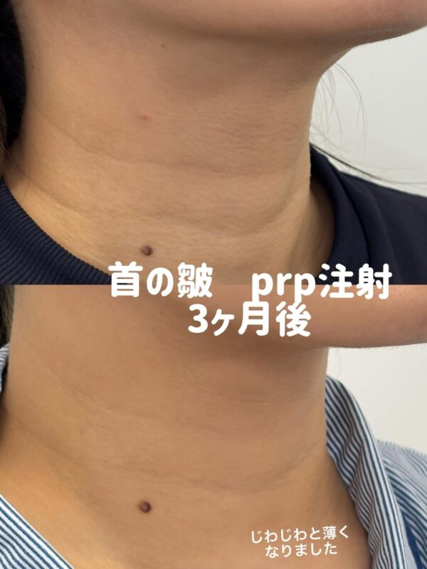 359 首のシワ PRP注射