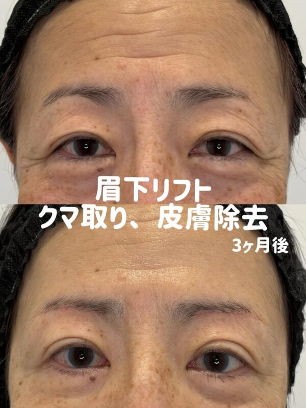 360 眉下リフト × クマ取り × 皮膚切除